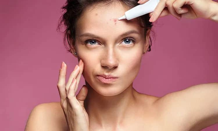Skuteczne sposoby na pryszcze: od domowych metod po aptekę