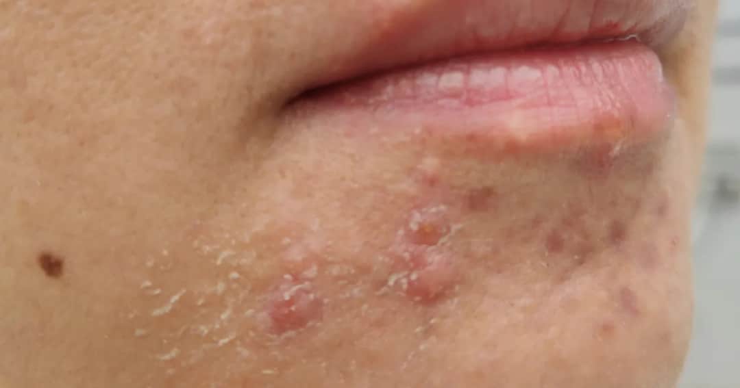 Pryszcze na brodzie: Skuteczne sposoby, przyczyny i leczenie